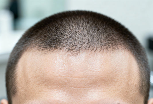 Autoimmun eredetű betegségek hatása a fejbőrre: Tudományos áttekintés fodrászok számára