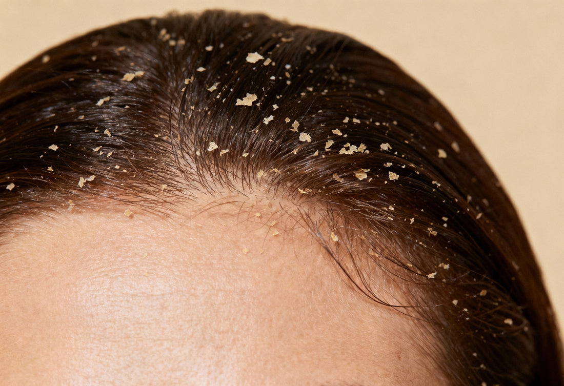 Közepes méretű korpa — Bioflóra-eltolódás, irritáció és mikrobiális folyamatok tudománya